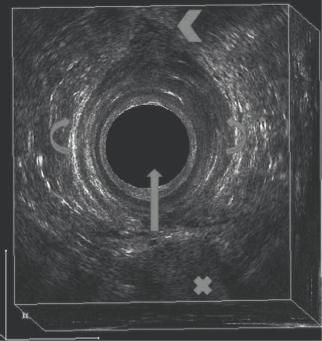 The use of transperineal ultrasound and endosonography using H2O2 in the diagnosis of perianal abscesses.