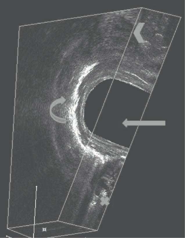 In all patients perianal abscess was located under the skin at the anal verge, in five children on the right side, in four on the left side.