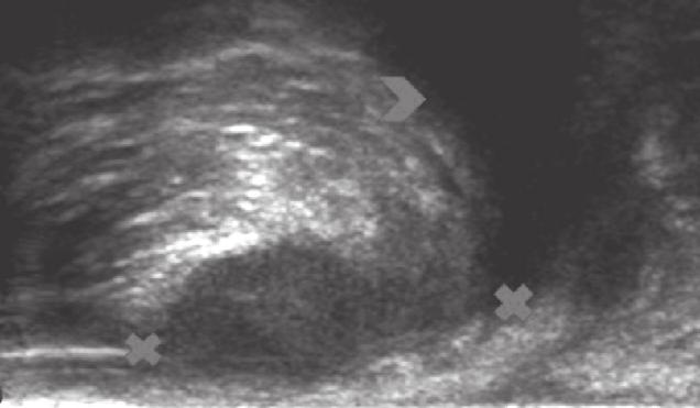 In the ultrasound examination, all patients had the typical hipoechogenic appearance of the abscess area, in 6 subjects with an irregular outline.