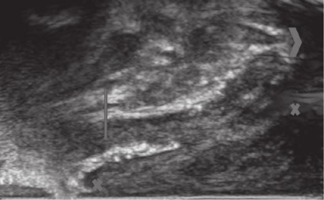 In 3 (50%) children transperinalgrayscale ultrasound showed a single fistula canal clearly visible in a form of a hypoechoic, narrow linear structure, in one (17%) there were hypoechoic, tubular