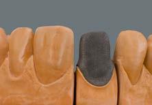 Modelacja podbudowy w przypadku wykonywania stopnia ceramicznego Podbudowa po obróbce i przygotowaniu pod stopień ceramiczny.