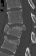 Typ urazu - kolumna tylna > może być nienaruszona Złamanie wybuchowe - duża siła urazu powoduje zgniecenie przedniej i środkowej kolumny