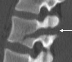 Typ urazu Złamanie Chance a - typowe złamanie kolumny kręgosłupa wzdłuż osi poprzecznej - zawsze współistnieje uraz tkanek miękkich - konieczne