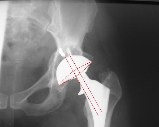 . Mutual arrangement of hip endoprosthesis elements (X-Ray images): a) acetabulum symmetry axis in relation to neck stem symmetry axis, b) acetabulum symmetry axis shifted from stem symmetry axis.