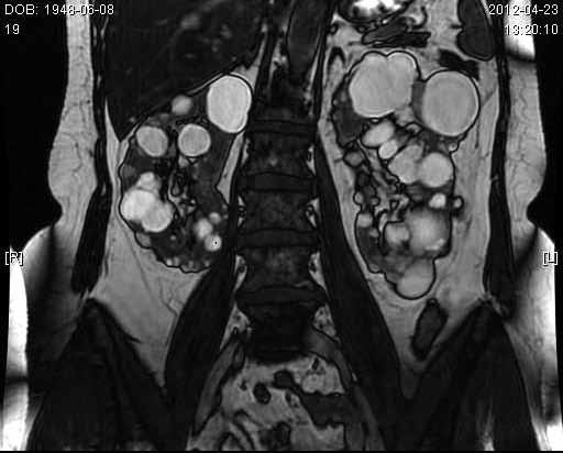 Rycina 4. Skan MRI obejmujący obie nerki zmienione wielotorbielowato (materiał własny autora) Rycina 3.