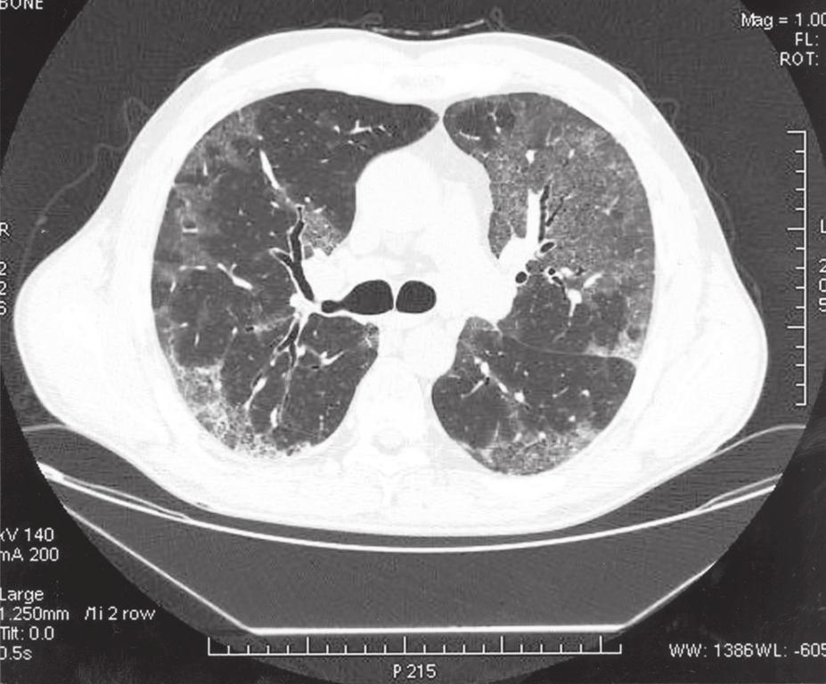 Pneumonologia i Alergologia Polska 2008, tom 76, nr 3, strony 186 191 Rycina 2. Tomografia komputerowa o wysokiej rozdzielczości (HRCT, high-resolution computed tomography).