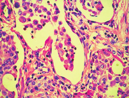 Great increase in previously described opacities Rycina 5. Tomografia komputerowa o wysokiej rozdzielczości (HRCT, high-resolution computed tomography). Trzy tygodnie po leczeniu prednizonem.