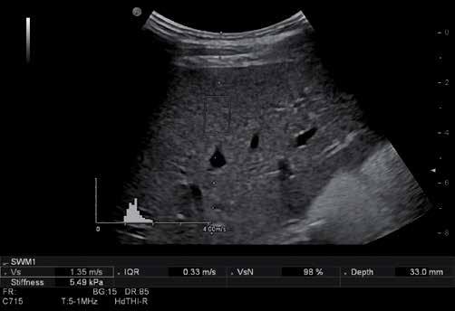 Shear wave elastography with a new reliability indicator A B C D Fig. 4. A healthy subject. Series of images showing the reliability of data (A E) Ryc. 4. Osoba zdrowa.