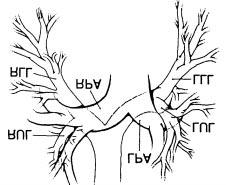 Rycina 6 a Rozk³ad izodoz nak³adaj¹cy siê na schematyczne po³o enie oskrzela g³ównego prawego (right mainstem bronchus) i têtnicy p³ucnej (pulmonary artery), widoczny aplikator (catheter) z izotopem