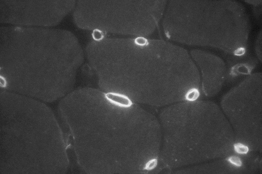 Rys. 2. Gen STA na d³ugim ramieniu chromosomu Xq28 Wszystkie one s¹ poœrednimi filamentami typu V.