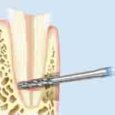 9 Chirurgia/ implantologia Surgery/ Implantology H141.104. 031 u H141.104. 035 u H141.104. 040 s H141Z.104. 045 s H141Z.104. 050 s H141A.104. 031 u H141A.104. 035 u H141A.104. 040 s 500 314 415296 H254.