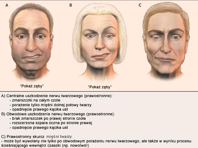 smaku i wydzielanie śliny. Nie uszkadza się mięsień czołowy i zachowana jest ekspresja twarzy. Objawy występują w okolicach policzka, wargi i szyi.