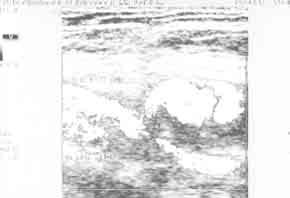 Acta Angiol., 2003, Vol. 9, No. 3 A B C D Figure 1. Pseudoaneurysm of the superficial femoral artery in a 57-year-old patient after coronaroplasty: A.