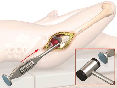 3.1 Implantacja bezcementowego trzpienia twinsys Po usunięciu raszpli należy zrezygnować z płukania jamy szpikowej z następującym potem płukaniem w celu wspomagania późniejszej osteointegracji.