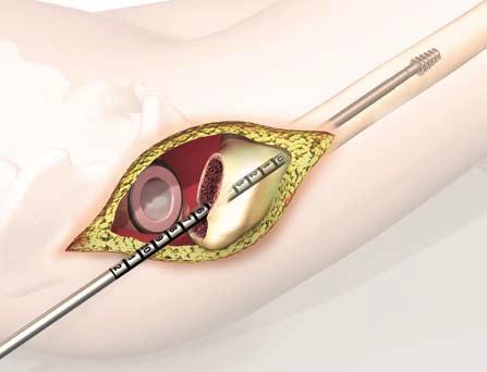 3.2 Implantacja cementowanego trzpienia twinsys Postępowanie operacyjne w celu implantacji trzpienia cementowanego jest identyczne jak w przypadku implantacji trzpienia bezcementowego do repozycji