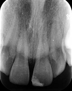Zniszczony pierwszy ząb trzonowy w tej okolicy szóstka u góry po prawej stronie.