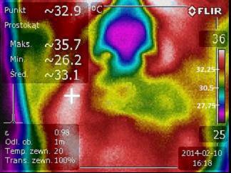 W celu zobrazowania ewentualnych zmian zapalnych tej okolicy wykonano zdjęcie kamerą termowizyjną. Widoczna różnica w rozkładzie temperatur. Przyczyną jest stan zapalny węzła podżuchwowego.