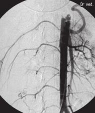 stent implantation; C. total revascularization of renal artery daniu fizykalnym zaobserwowano niewielkie obrzęki podudzi, głównie wokół kostek.