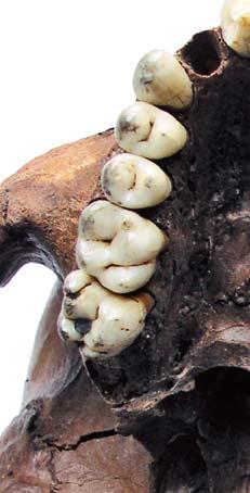 Fig. 5. Dental restoration in the right M2. Il. 5. Wypełnienie stomatologiczne w prawym M2.