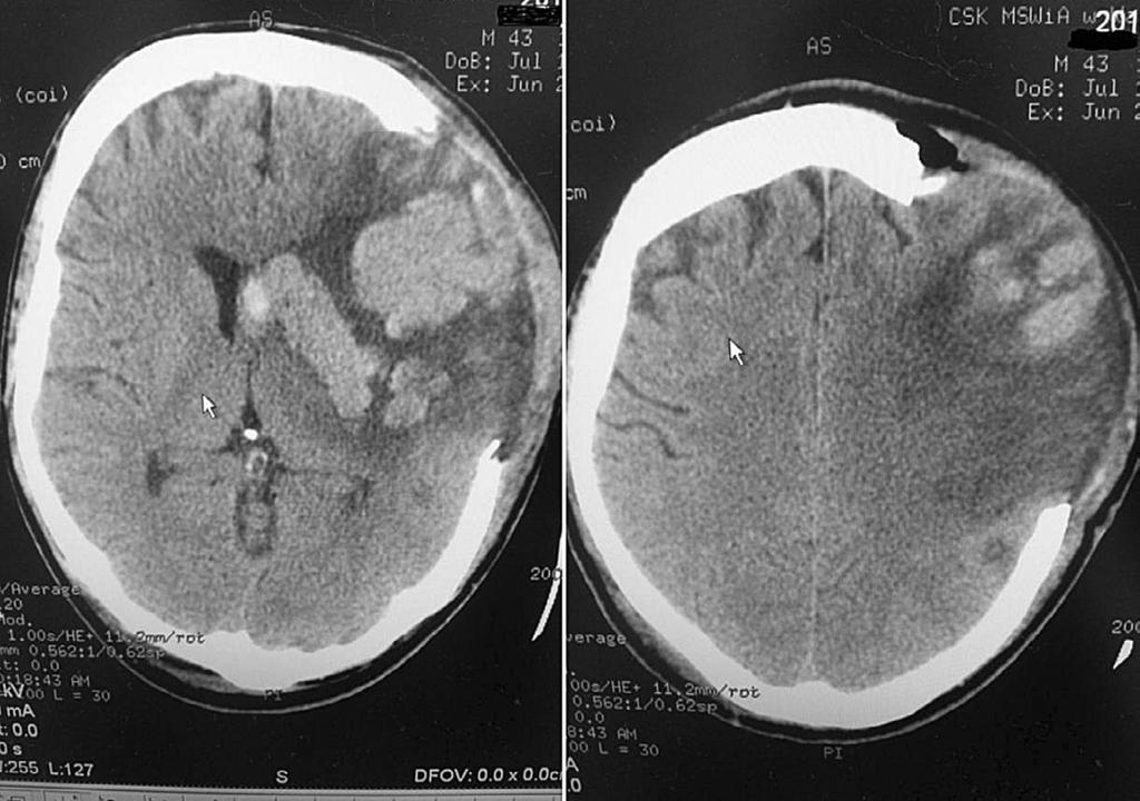 Obraz tomografii komputerowej (TK) mózgu kontrolne badanie pooperacyjne stan po przebytej hemikraniektomii lewostronnej z odbarczeniem kostno-oponowym ką afazję mieszaną: chory wypowiadał pojedyncze