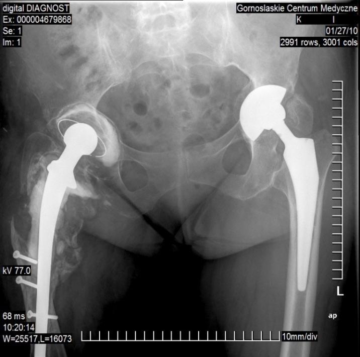 Brown NM i wsp: Modular Tapered Implants for Severe Femoral Bone Loss in THA: Reliable