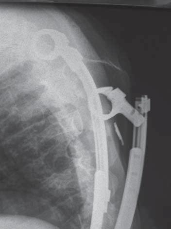 Does VEPTR meet the expectations? indications. [3,4,5,6,7] it seems that surgery utilising the vertical expandable titanium rib is a method of choice in the treatment of youngest children.