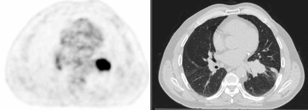 terapii. Zasada ta została wykorzystana przy tworzeniu nowego systemu oceny odpowiedzi na leczenie guzów litych w badaniu PET (PERCIST, PET Response Criteria in Solid Tumors) [29].