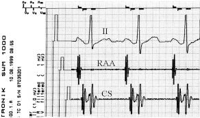 Folia Cardiol. 2001, tom 8, nr 3 Ryc. 7. Przykład wykorzystania zapisów potencjałów wewnątrzsercowych (IEGM) w celu kontroli dwuprzedsionkowego układu stymulującego.