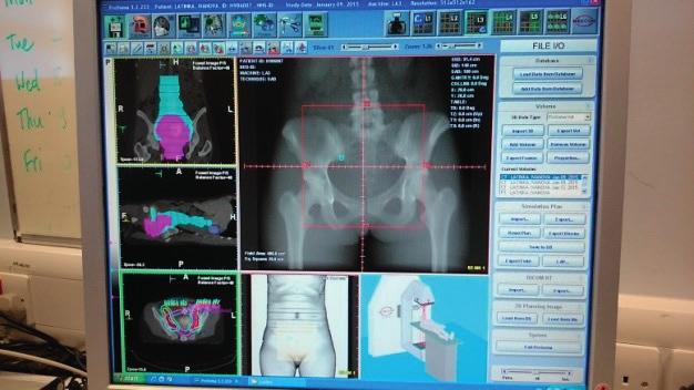 10 Widok ekranu TPS Pinnacle na skanach TK są widoczne struktury reprezentujące 10 Gy i 20 Gy izodozy oraz kontur węzłów chłonnych miednicy i