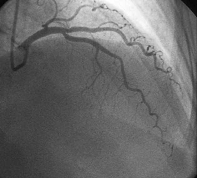 location might cause life-threatening complications such as total occlusion with acute coronary syndromes.