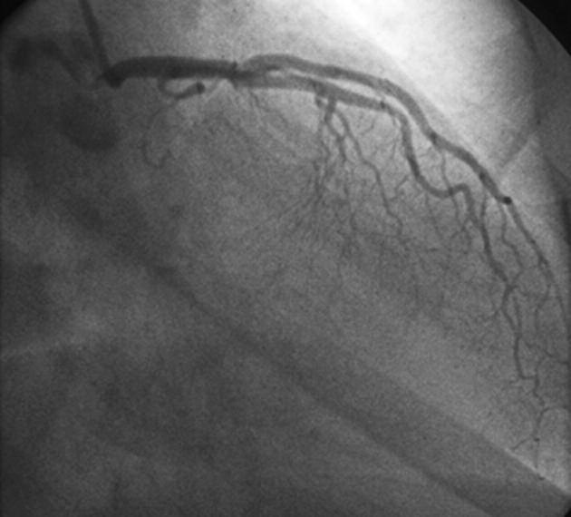 anomalies. Case report A 48-year-old woman was admitted to our hospital with atypical precordial chest pain for 2 years.