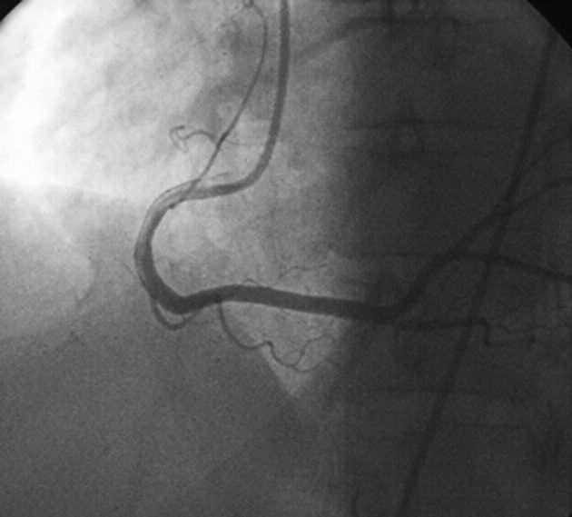 On coronary angiography, the left coronary arteriogram showed only one artery arising from the left sinus of Valsalva and continuing as a single left anterior descending coronary artery (LAD) which