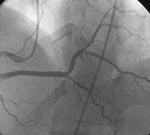 Then selective right coronary angiography revealed a superdominant right coronary artery (RCA) B C D Fig. 1 A D.