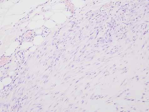 Potrójnie ujemny rak sutka (triple-negative breast cancer) jednorodna czy heterogenna grupa