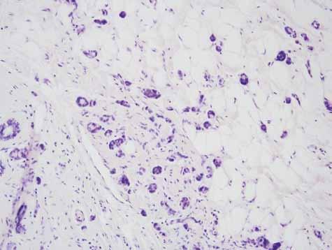 Janusz Ryś, Anna Kruczak Rycina 9. Rozrost o typie microglandular adenosis.