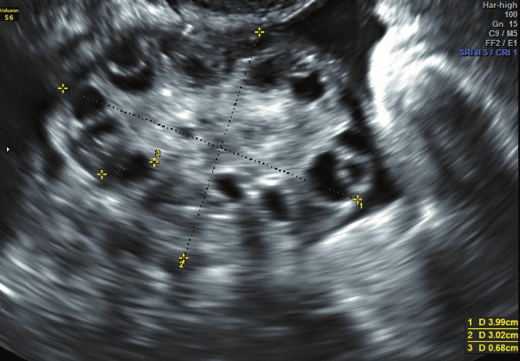 Michał Bachanek, Nebil Abdalla, Krzysztof Cendrowski, Włodzimierz Sawicki probes revealed that the diagnostic threshold of the follicle number for PCOS women is about 25(26,28).