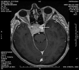 wrasta do światła zatoki klinowej; w okolicy nadsiodłowej guz przemieszcza skrzyżowanie nerwów wzrokowych, a po prawej stronie wrasta do zatoki jamistej i otacza prawą tętnicę szyjną;