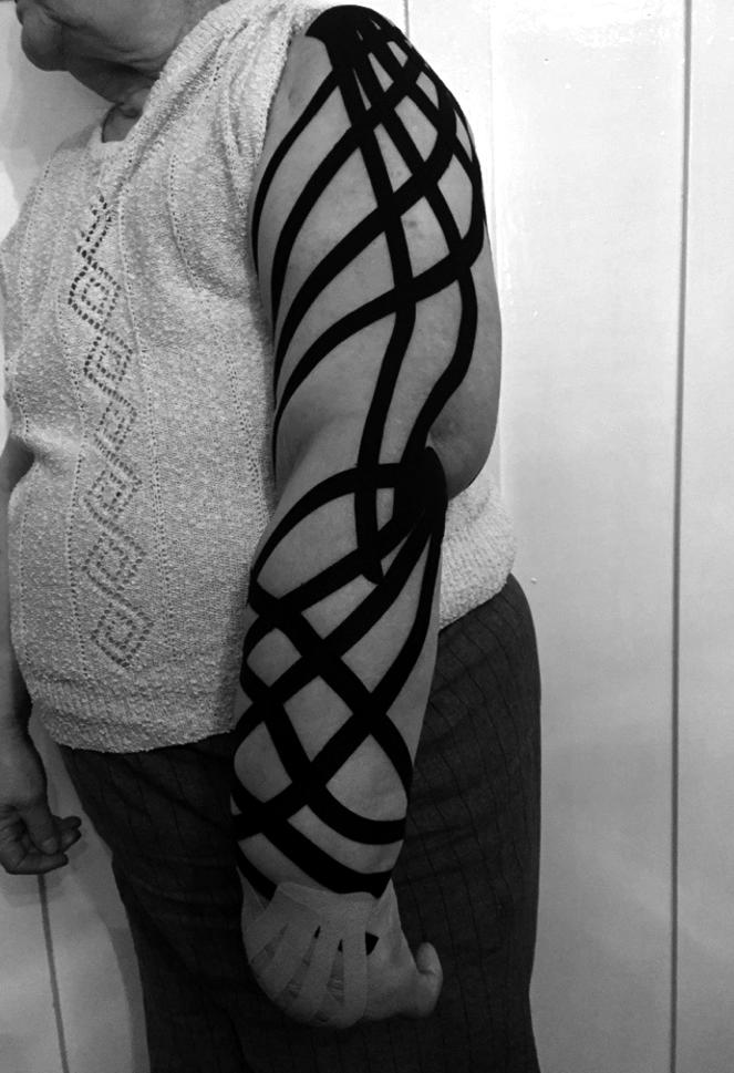 Medycyna Paliatywna w Praktyce 2015, tom 9, nr 2 Rycina 1. Kinesiology taping aplikacja limfatyczna na kończynę górną aktywności i samodzielności w życiu codziennym [1, 2].