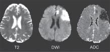Polski Przegląd Neurologiczny, 2005, tom 1, nr 1 Rycin 11.