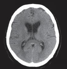 Polski Przegląd Neurologiczny, 2005, tom 1, nr 1 czego fotonu (SPECT, single-photon emission computed tomogrphy), metolizmu [spektroskopi MR, pozytronow tomogrfi emisyjn (PET, positron emission