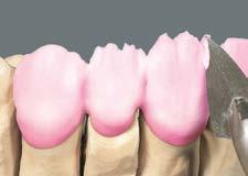 Nakładanie warstw wg schematu BUILD UP Nałożenie VITAVM 9 TRANSPA DENTINE Masą TRANSPA DENTINE