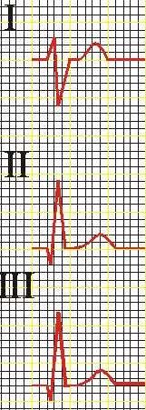 QRS 120ms EKG z szerokimi zespołami QRS LPH LAH