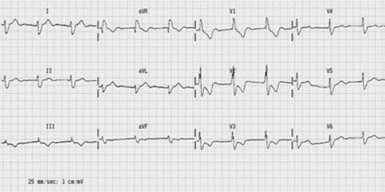 Rycina 3. Schemat tworzenia się RBBB (źródło: H.H. Boerger. EKG-Information, Wyd.