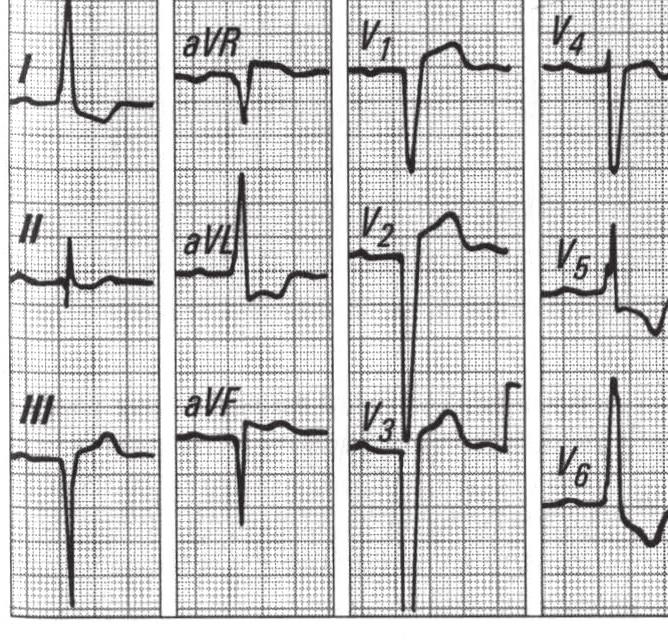 QSr w odprowadzeniach VI i V 2, a nawet VI> V 2 i V 3, mogą być wyrazem nieprawidłowego toru depolaryzacji komór, wywołanego blokiem lewej odnogi.