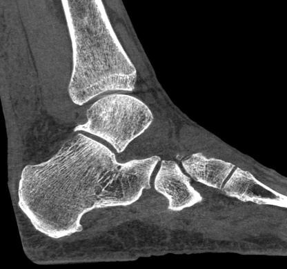 Ponadto wiele ostatnich publikacji wskazuje, że typowy zakres dawek stosowanych w systemach CBCT (CTDIvol na poziomie ~5 10 mgy) jest na ogół niższy od dawek stosowanych w TK