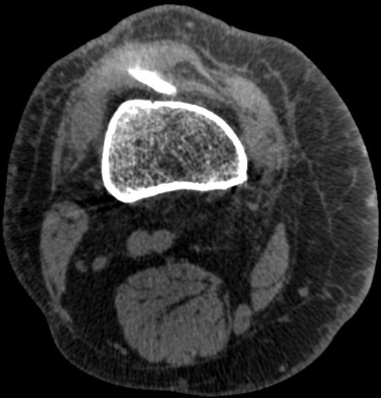 Z uwagi na zwiększoną objętość obrazowanych jednocześnie struktur w CBCT rozproszenie