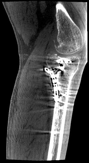 Jak w tradycyjnej TK obecność obiektów silnie osłabiających promieniowanie, takich jak implanty metalowe, może poważnie ograniczyć użyteczność kliniczną