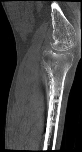 Metal Artifact Reduction, MAR) w celu poprawy widoczności struktur anatomicznych pacjenta położonych obok metalowych elementów. (Patrz Rysunek 7).