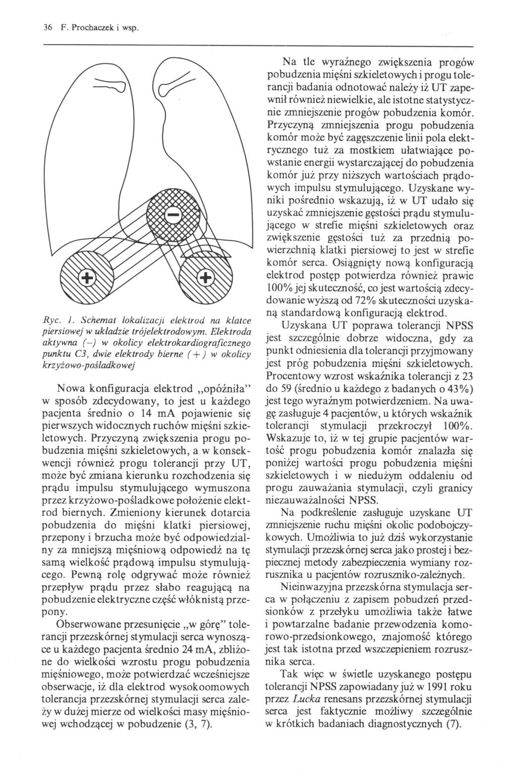 36 F. Prochaczek i wsp. Ryc. l. Schemat lokalizacji elektrod na klatce piersiowej w układzie trójelektrodowym.