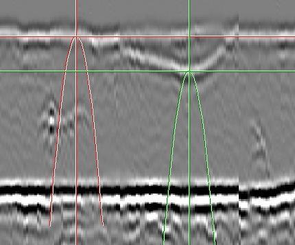 Metoda 1 Metoda 2 Metoda 3 Rys. 7. Metody pozycjonowania kursora na impulsach ultradźwiękowych w celu pomiaru głębokości i wysokości wskazań.